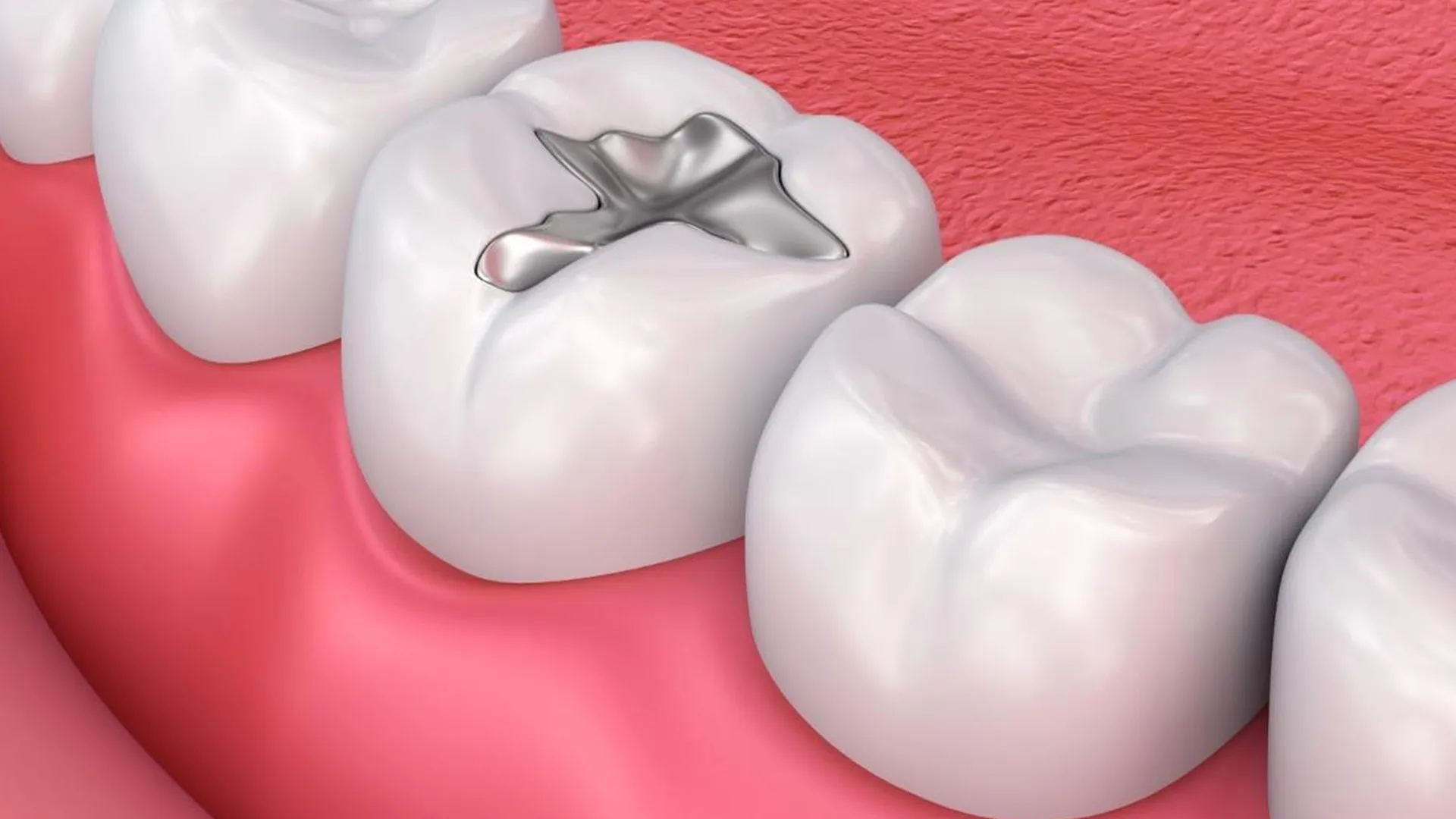Tooth with silver dental filling illustration.