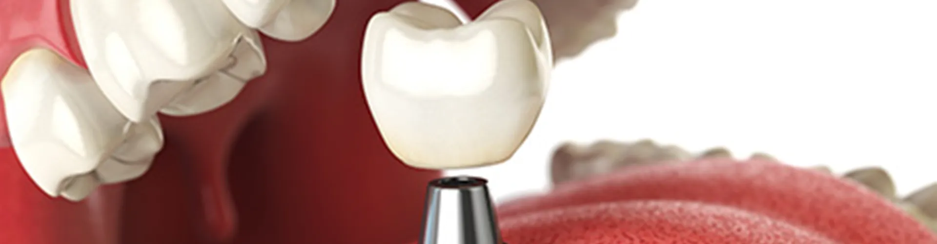 3D illustration of a dental implant.