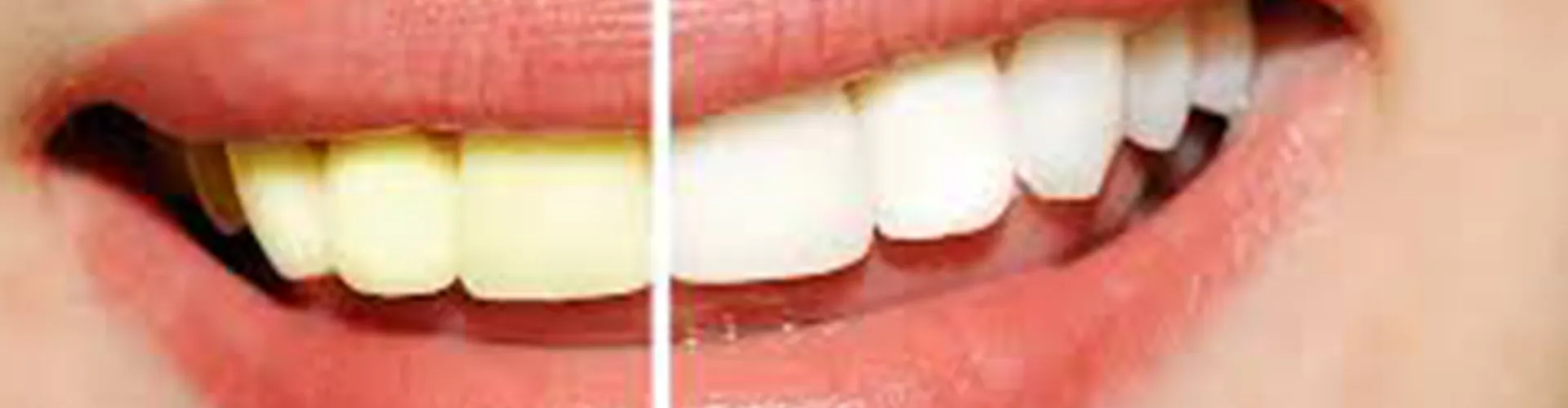 Smile comparison showing half white teeth and half yellow teeth.
