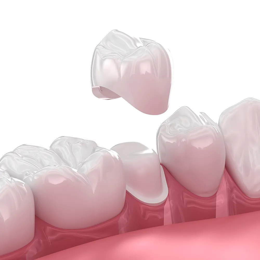 Dental crown being placed over prepared tooth.