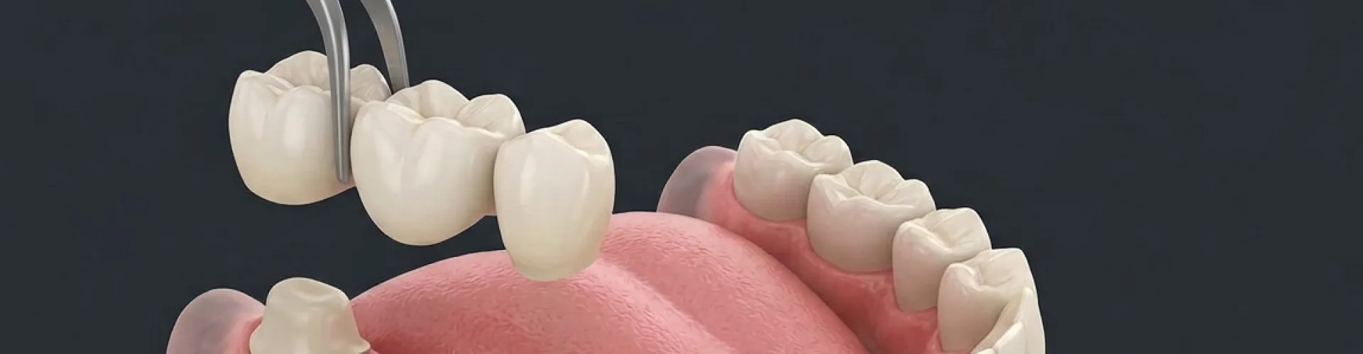 Rendering of a 3 crown bridge being placed onto two teeth with a space between.