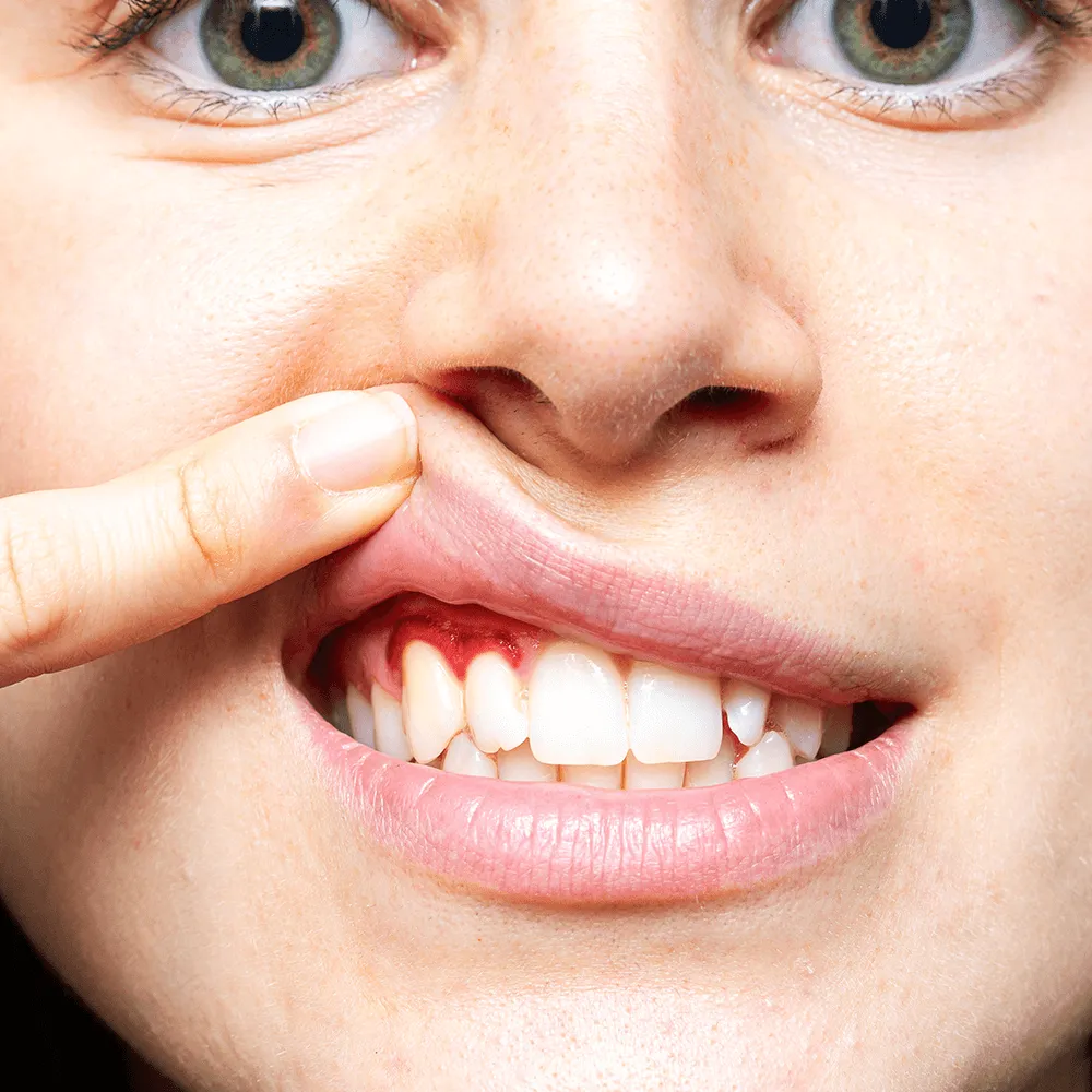 Close-up of gums with gingivitis, showing inflammation and redness.