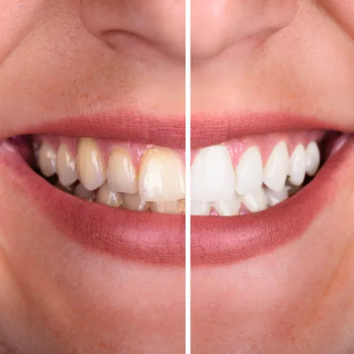 Split photo of a woman's smile before and after teeth whitening.