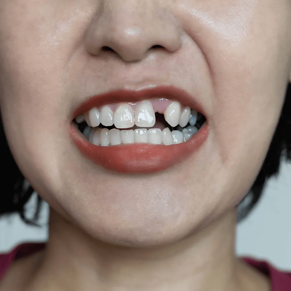 Close-up of a woman's mouth showing a missing tooth.