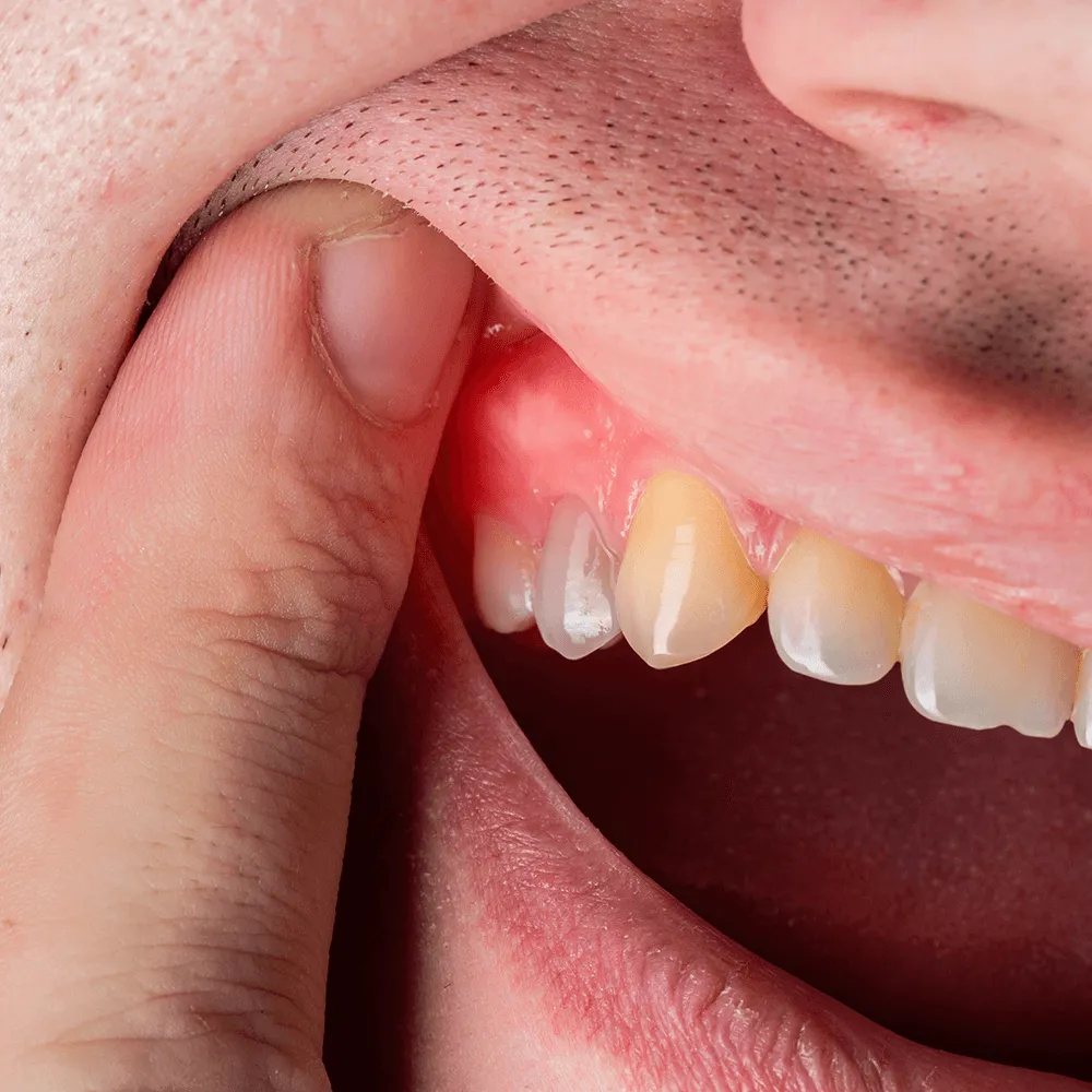 Close-up of inflamed gums near a tooth.  Possible gum disease.