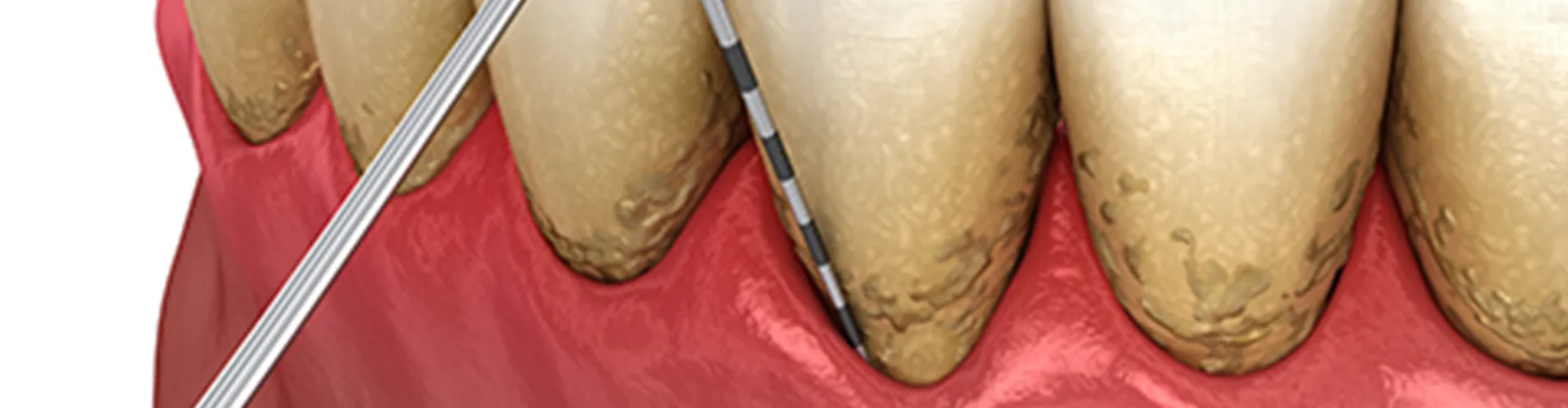 Rendering of dental pool scraping buildup off teeth.