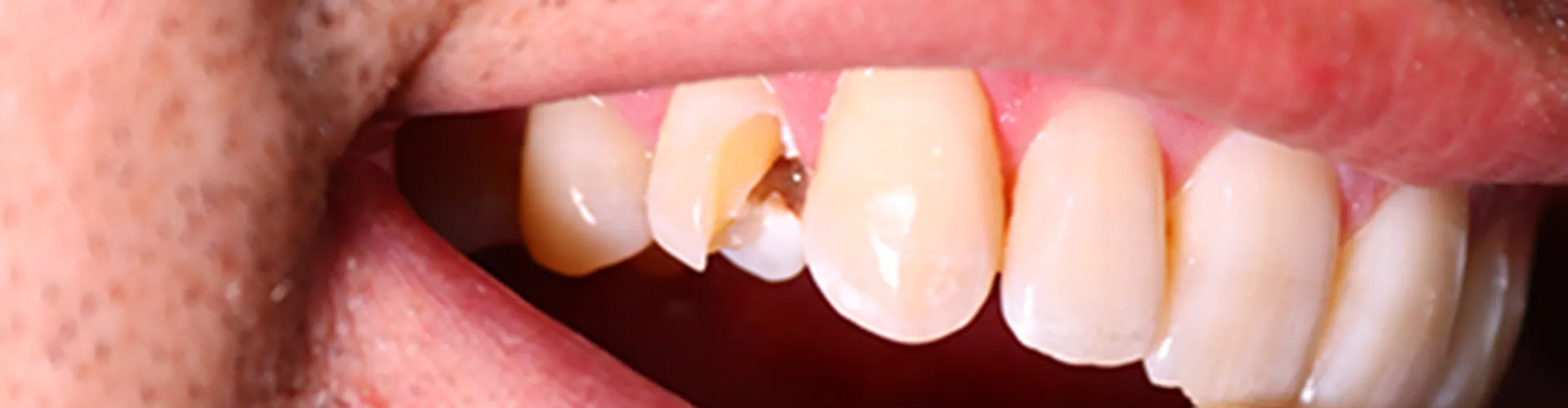 Mans smile with broken tooth.
