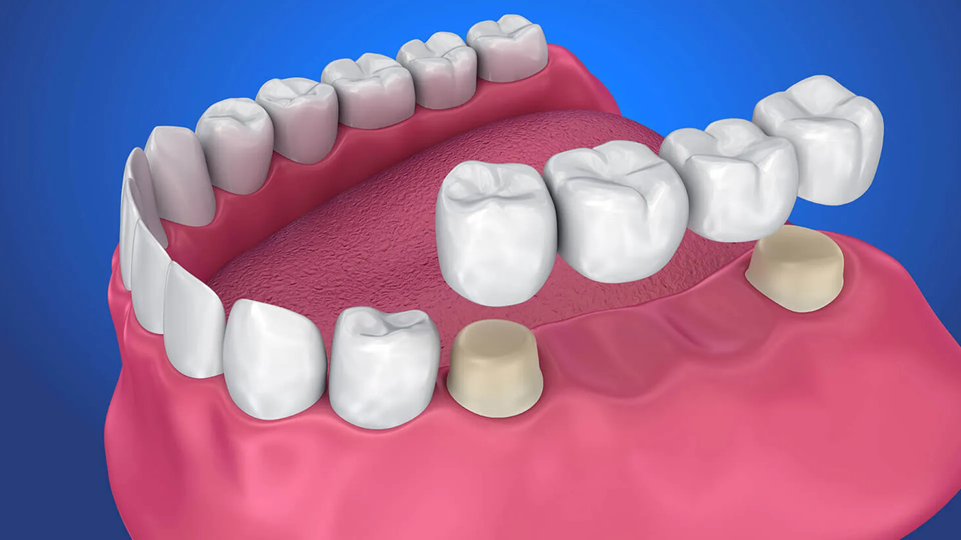 Dental bridge illustration showing replacement teeth.