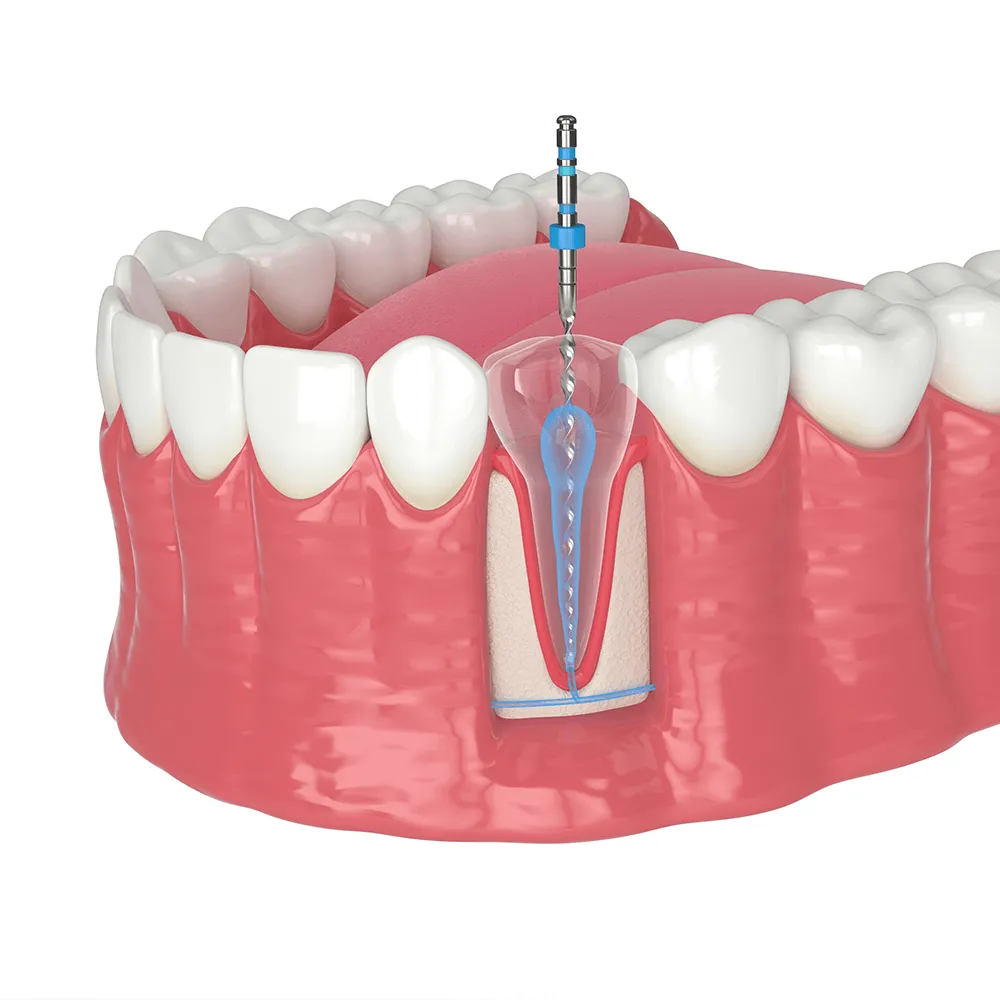 Dental implant surgery: Drill inserting implant into jawbone.