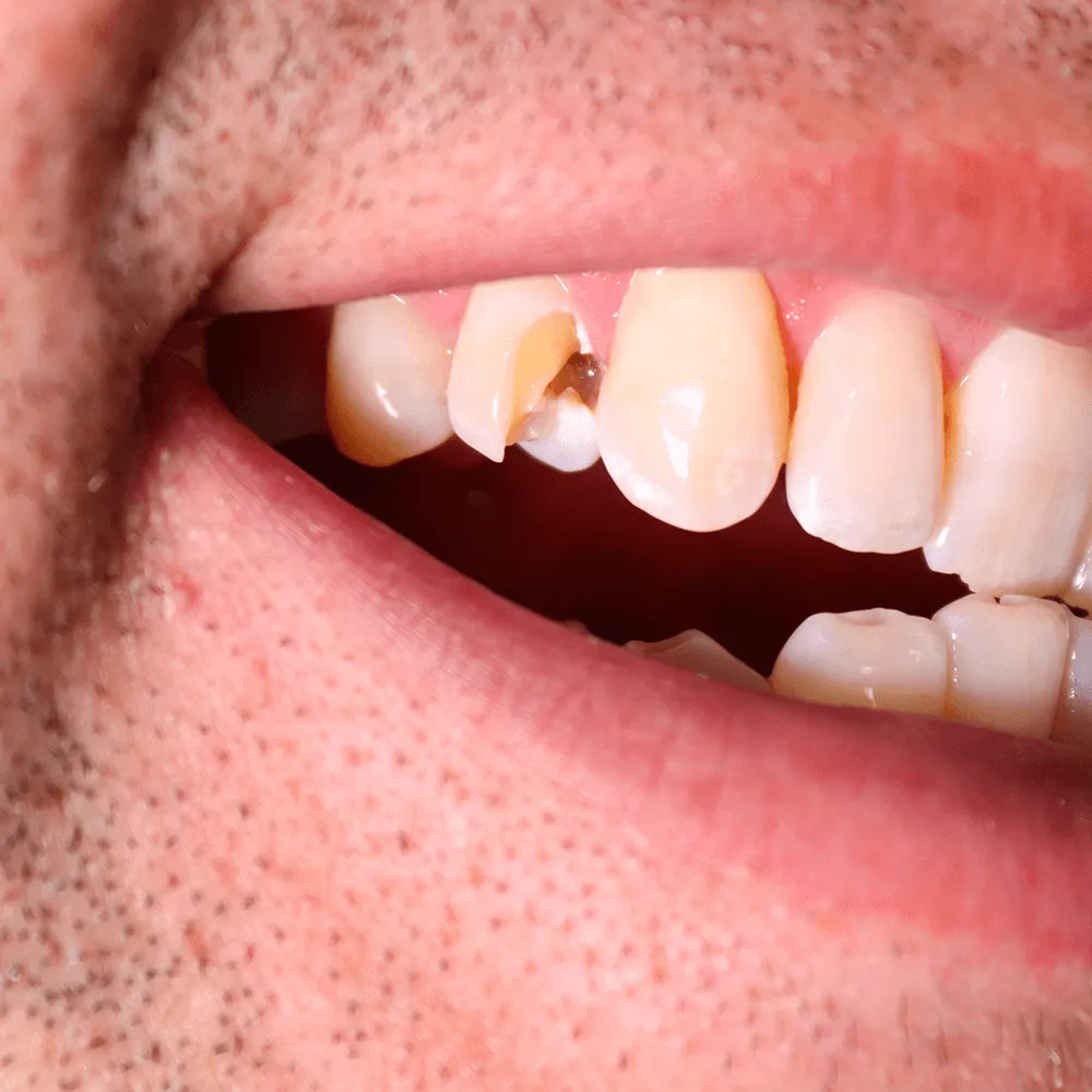 Close-up of a chipped tooth requiring dental repair.