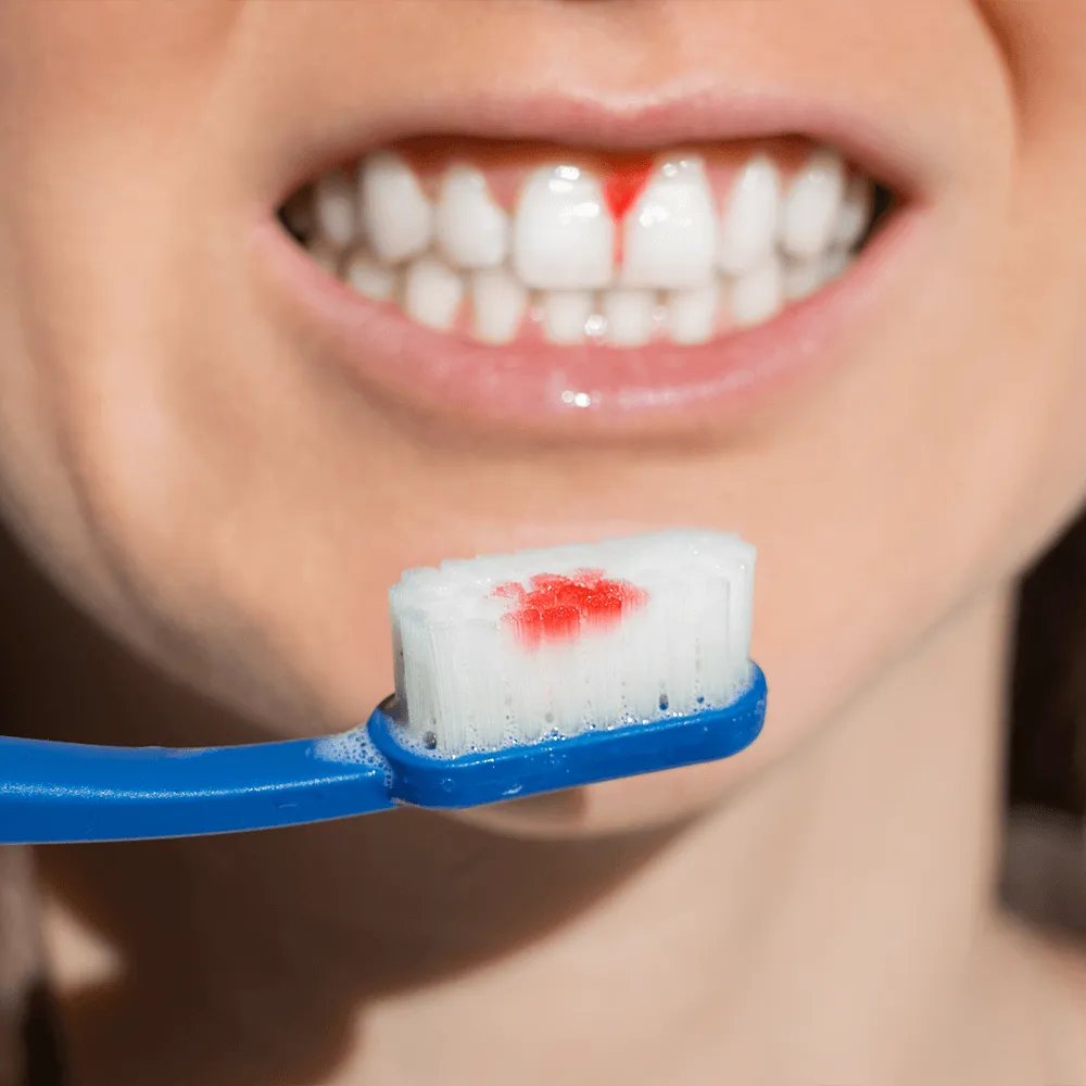 Close-up of toothbrush with blood, indicating bleeding gums.