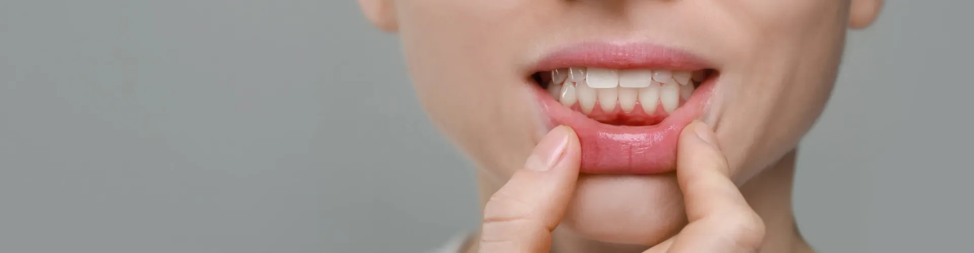 Close-up of a person showing signs of gum infection and periodontal disease inflammation.