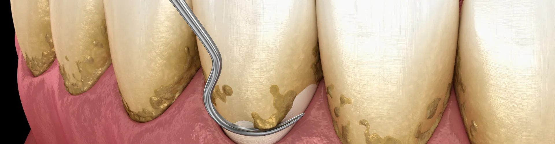 Rendering of a scraper removing buildup from teeth.