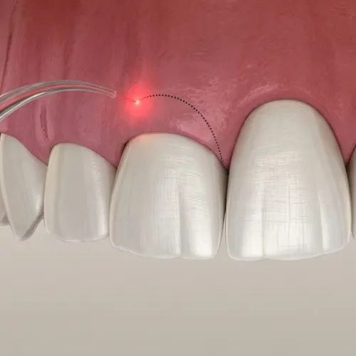 3D illustration of dental laser gum contouring reshaping the gumline around a front tooth.