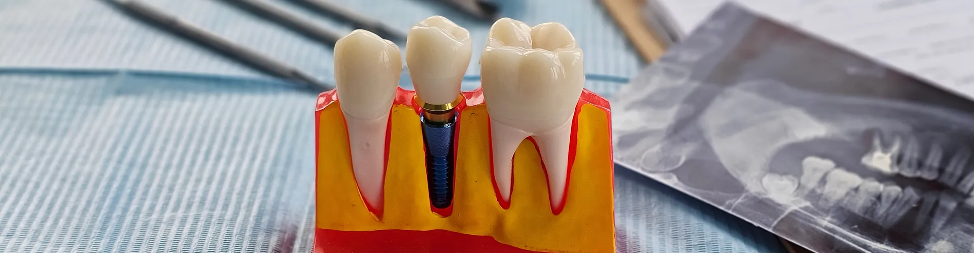 Model of a dental implant between two teeth.
