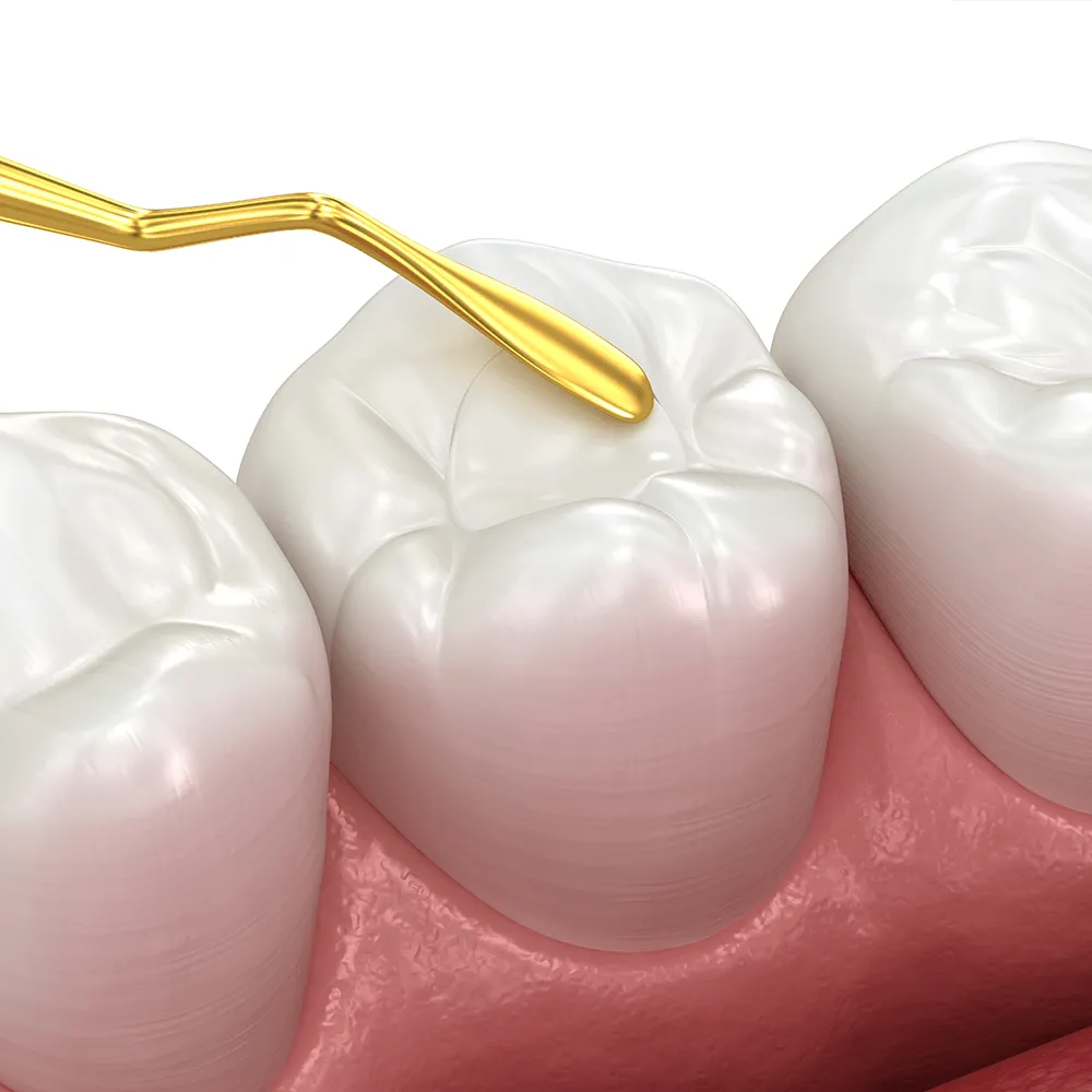 Dental filling procedure: Gold dental instrument applying composite resin to a molar.