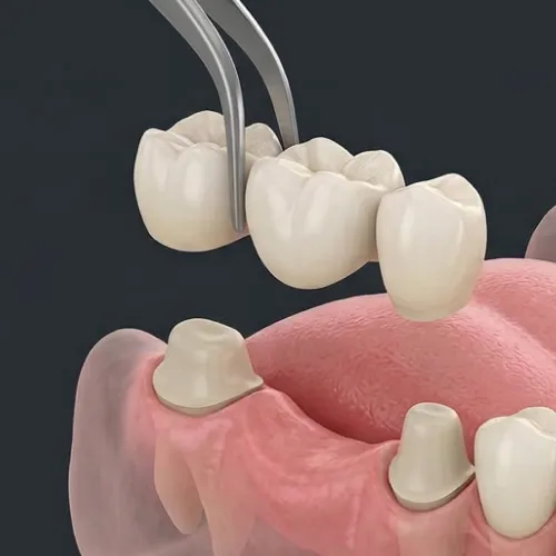 Rendering of a 3 crown bridge being placed onto two teeth with a space between.