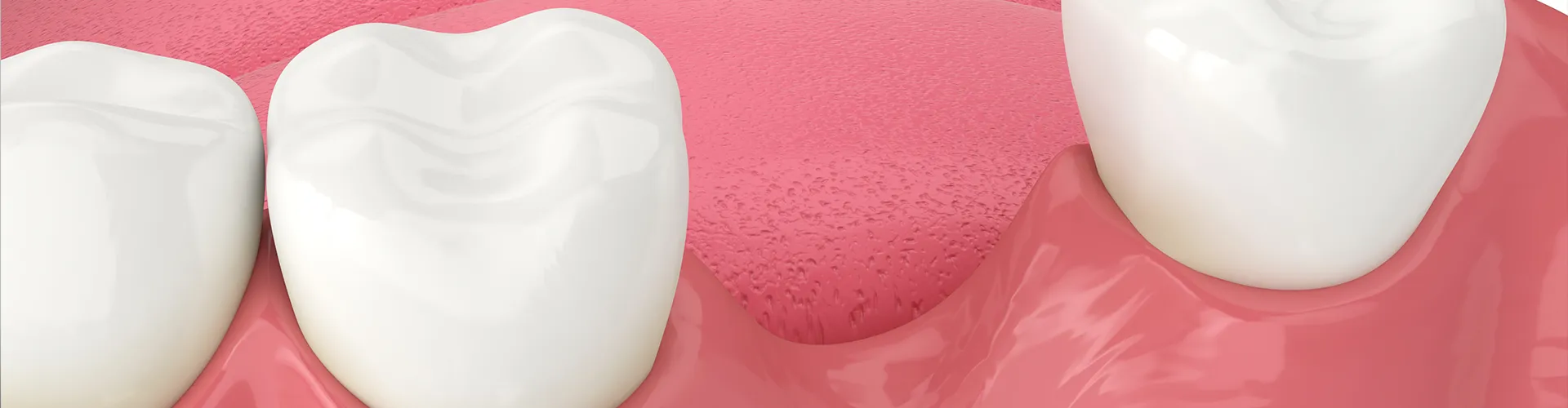 Rendering of a gap between 2 teeth from an extracted tooth.