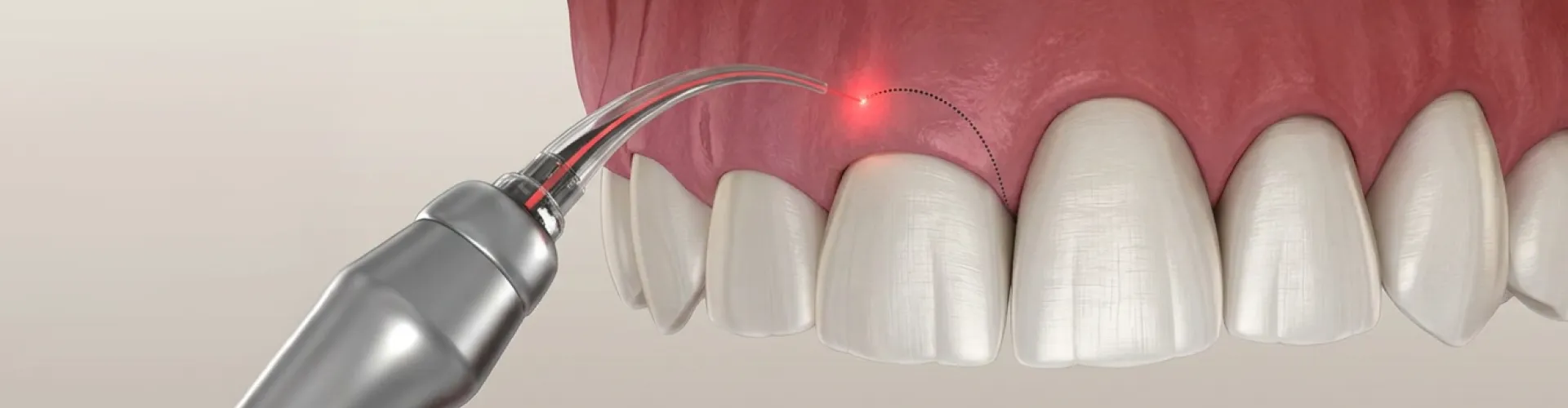 3D illustration of dental laser gum contouring reshaping the gumline around a front tooth.