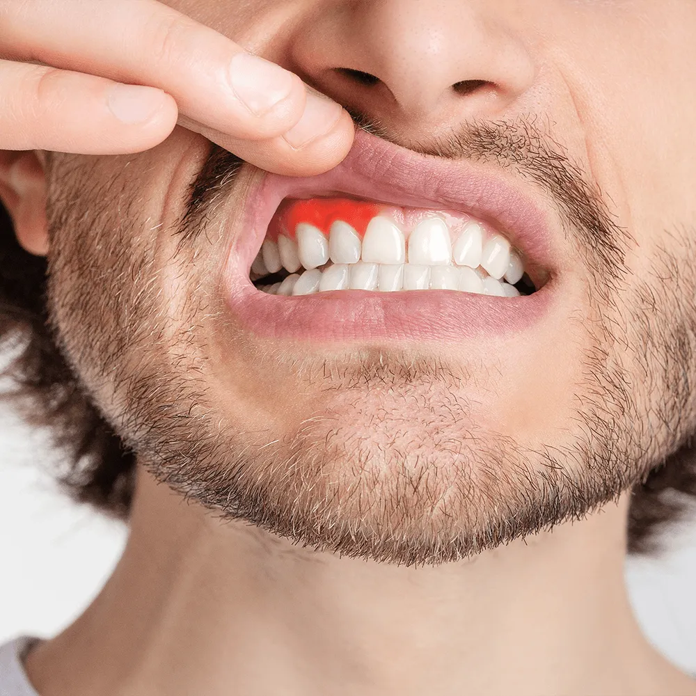 Close-up of man's mouth showing inflamed gums near a tooth. 