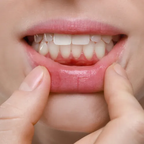 Close-up of a person showing signs of gum infection and periodontal disease inflammation.