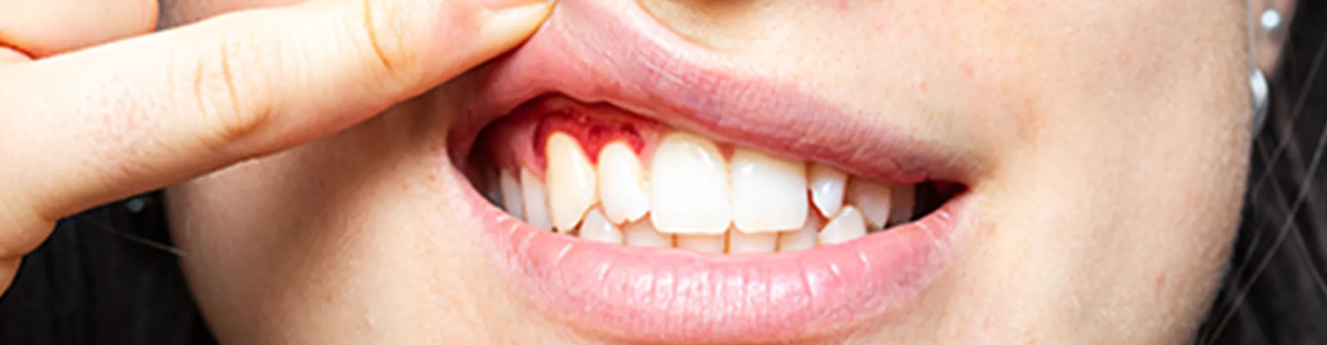 Woman lifting lip to reveal inflame dgums.