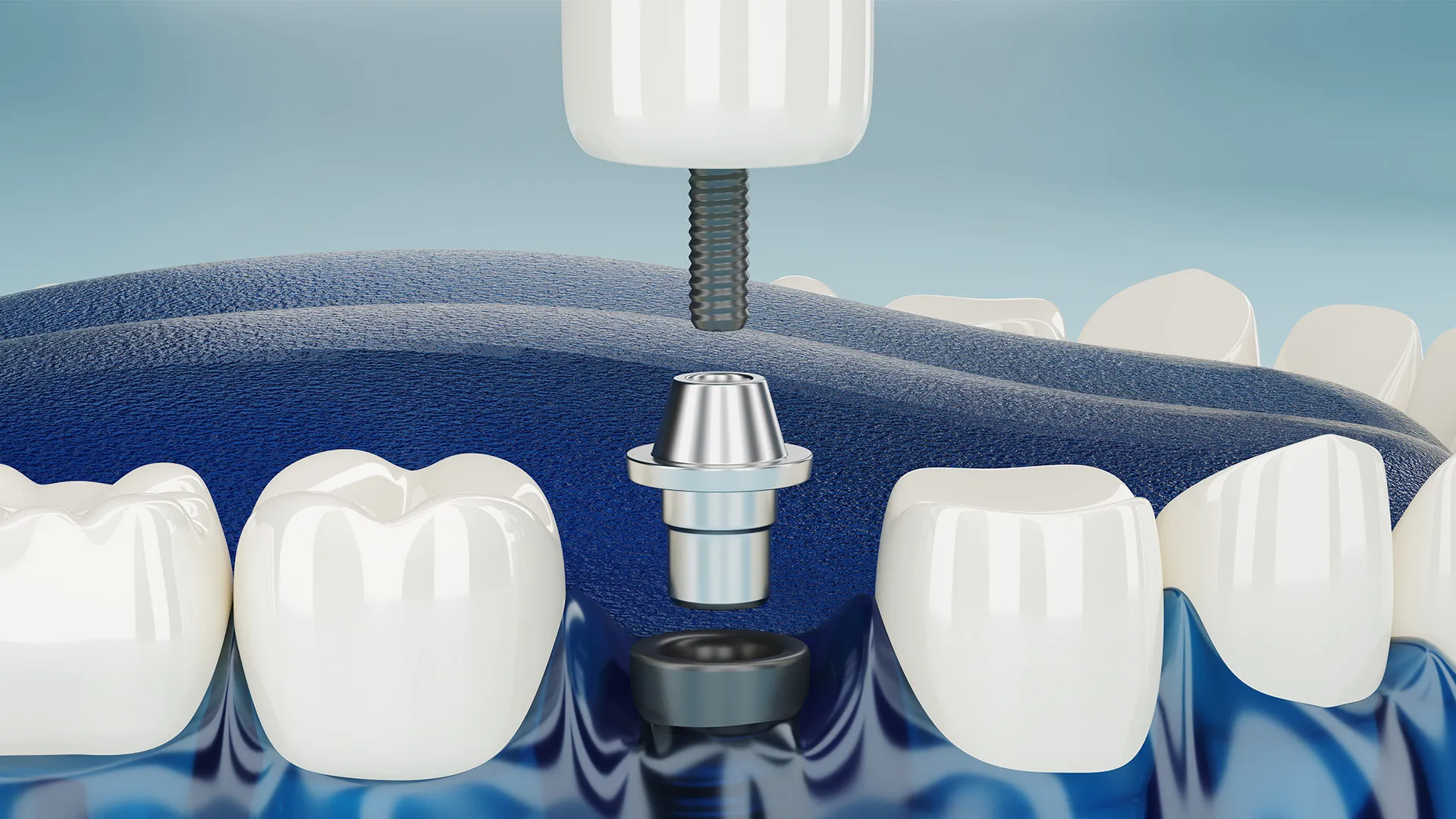 Dental implant illustration with crown and screw.