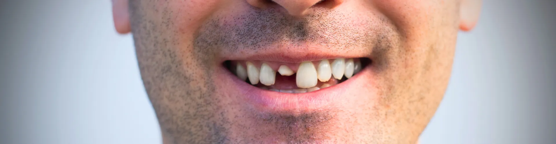 Man's smile with a broken-off front tooth.