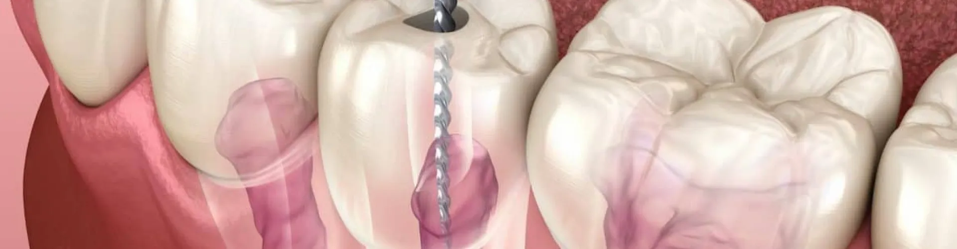 Rendering of a root canal tool inserted into a semi-transparent tooth.