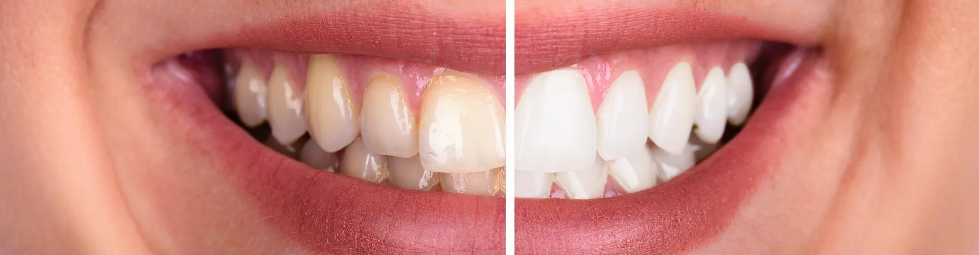Split photo of a woman's smile before and after teeth whitening.