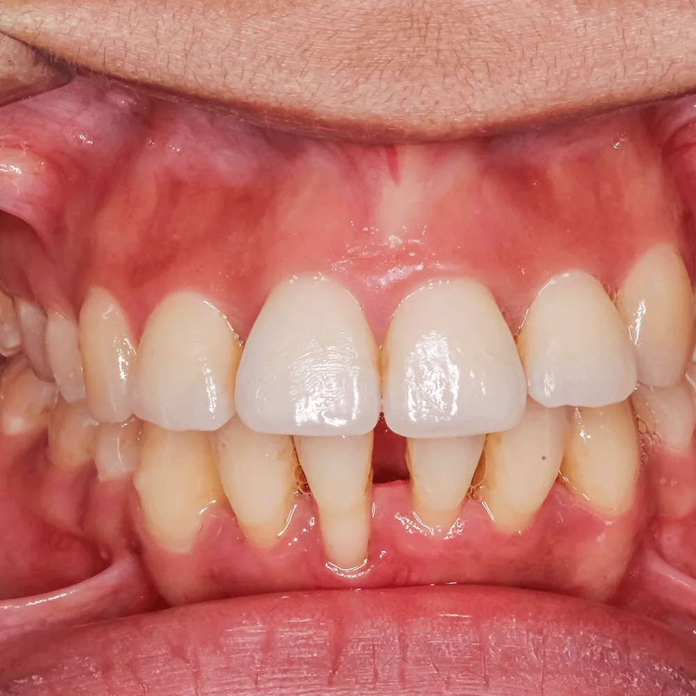 Close-up of healthy teeth and gums after dental treatment.