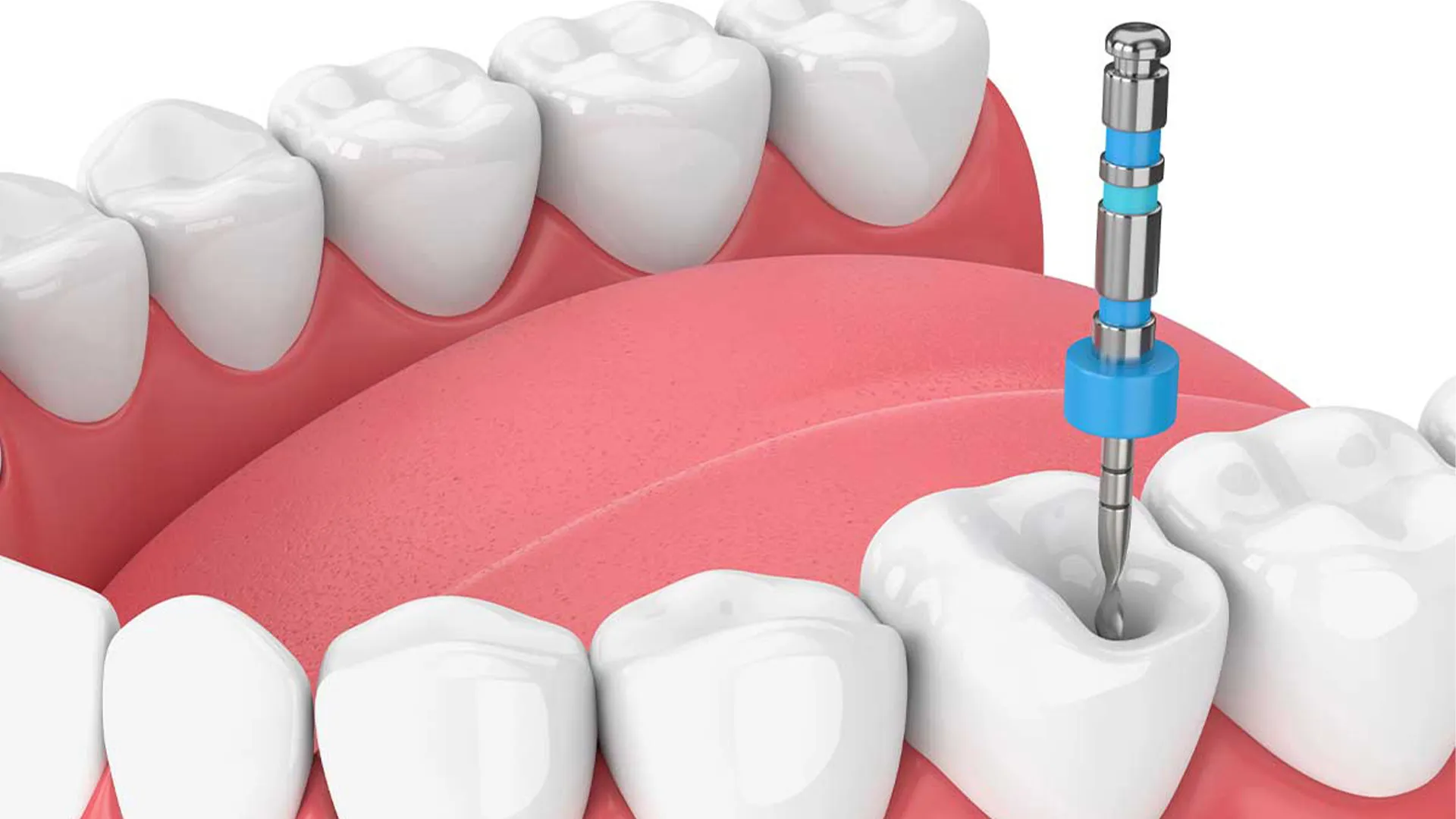 Illustration of tooth undergoing root canal.