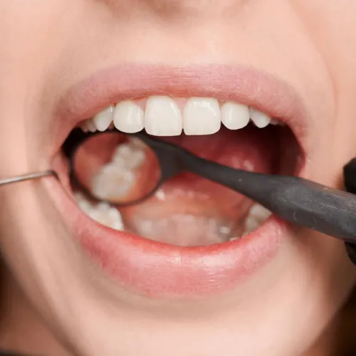 Dentist using tools for a cavity filling for a Woodland Hills patient.