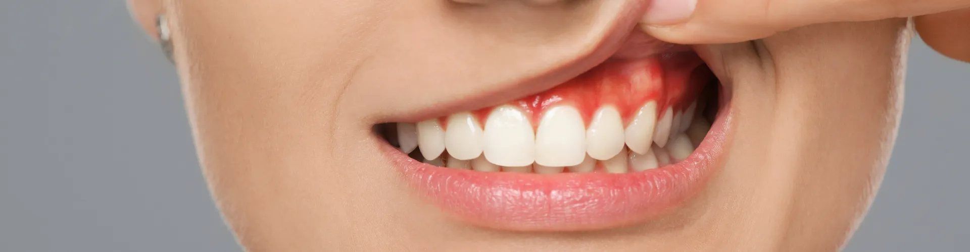 Woman lifting upper lip to show inflamed gums.