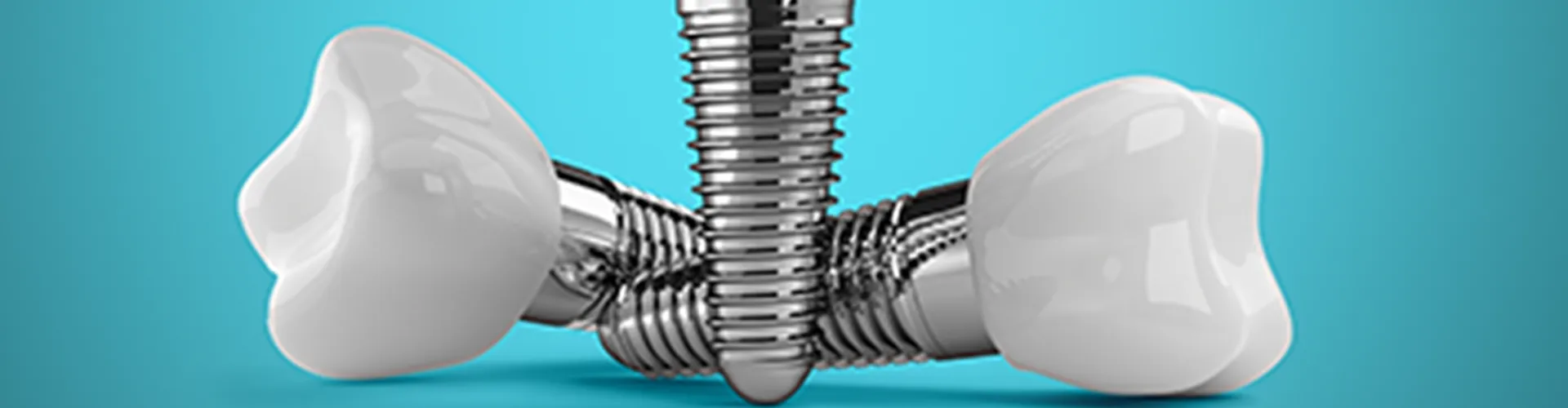 3D illustration of a dental implant.