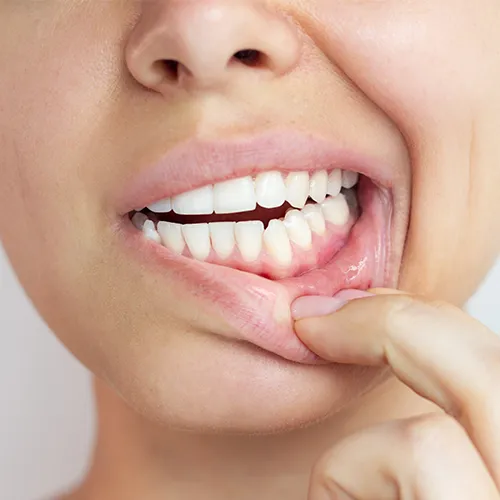 Woman pulling down bottom lip to show gums.