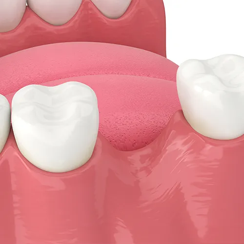 rendering of a gap between 2 teeth from an extracted tooth
