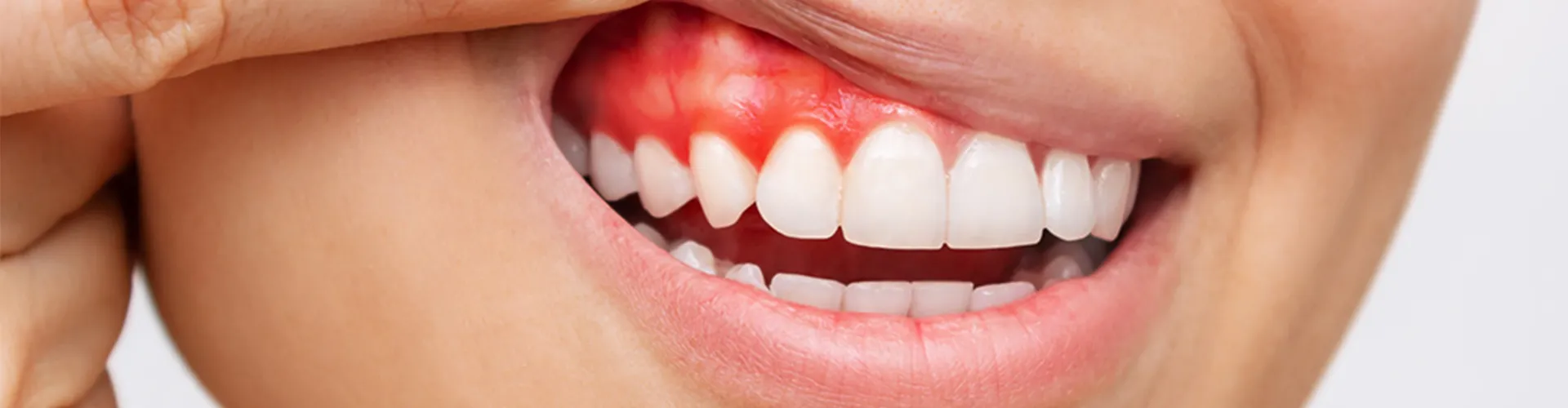 A woman pushing up her upper lip to show irritated gums.