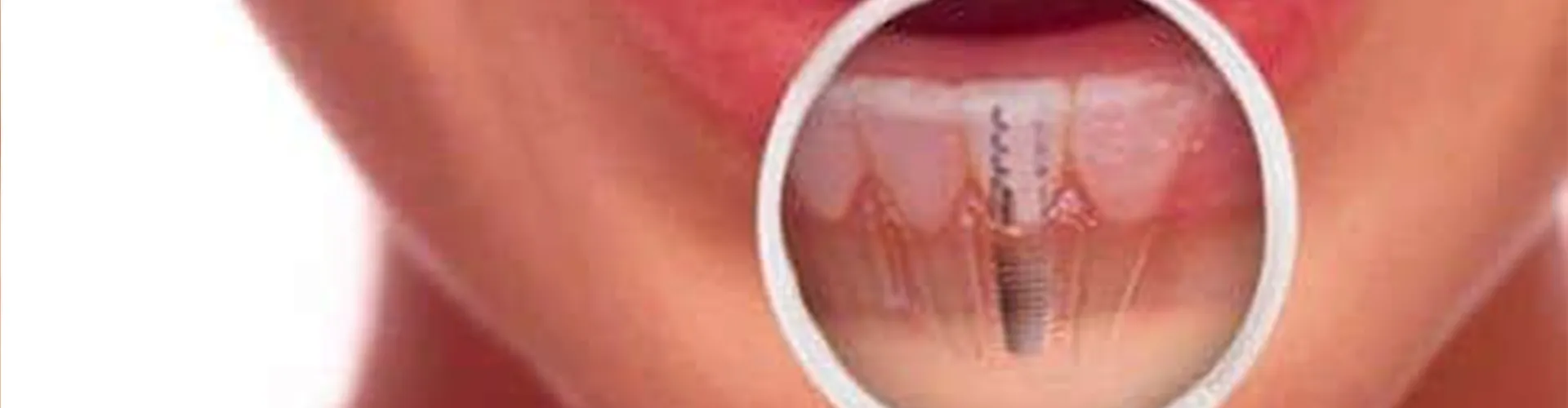 Close-up of a smile with bottom lip showing transparent view of a dental implant.