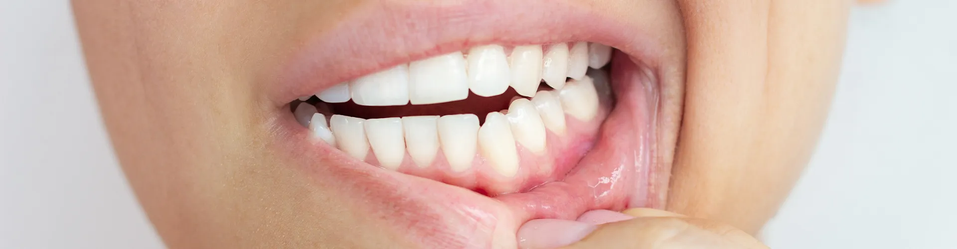 Woman pulling down bottom lip to show gums..