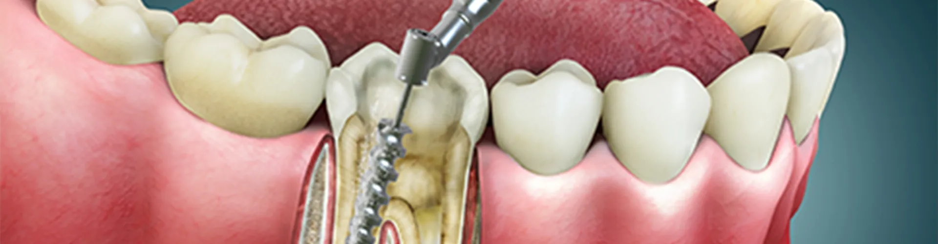 3D illustration of a tooth getting a root canal.