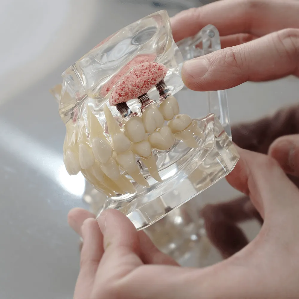 Dental model showing two dental implants supporting a partial denture.