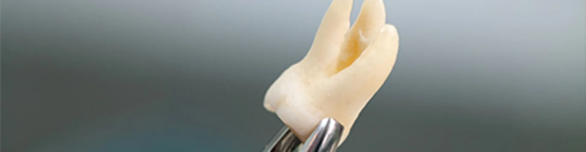 Dental pliers holding extracted tooth.