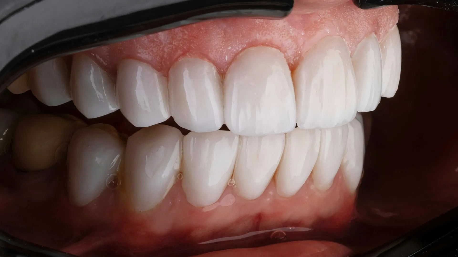 Close-up of gums showing healthy teeth