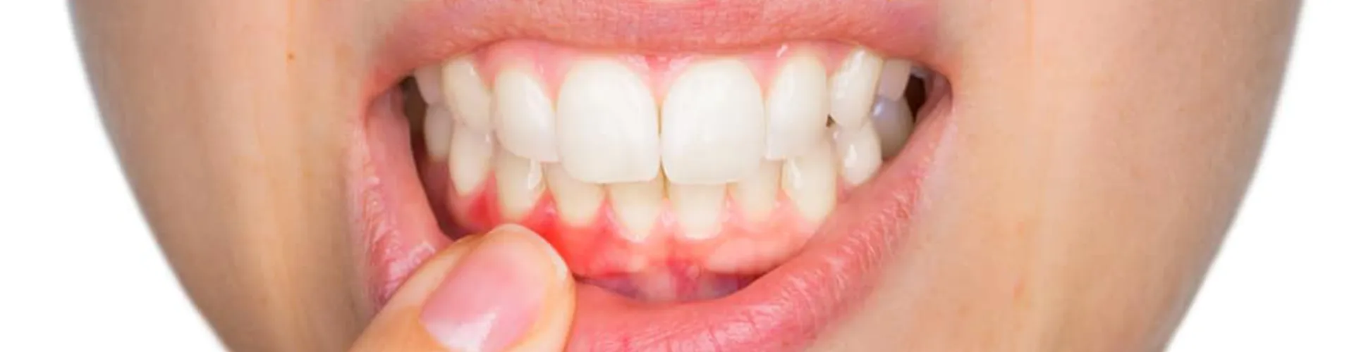 A woman pulling down her bottom lip to show irritated gums.