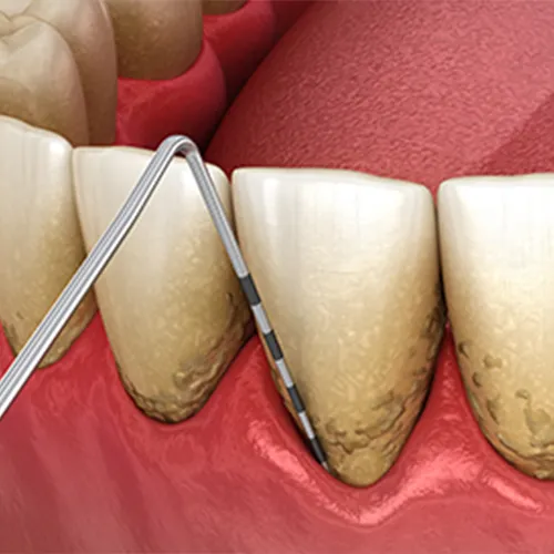 rendering-of-dental-pool-scraping-buildup-off-teeth