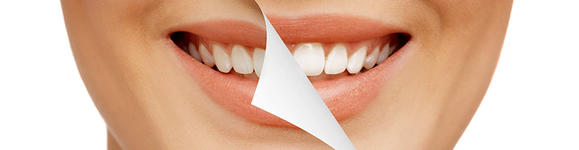 Close-up of a smile with overlay showing transformation to whiter teeth.