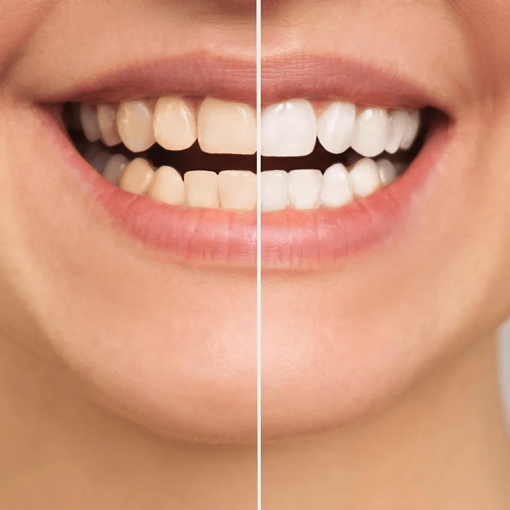 Before & after teeth whitening: yellow teeth become bright white.