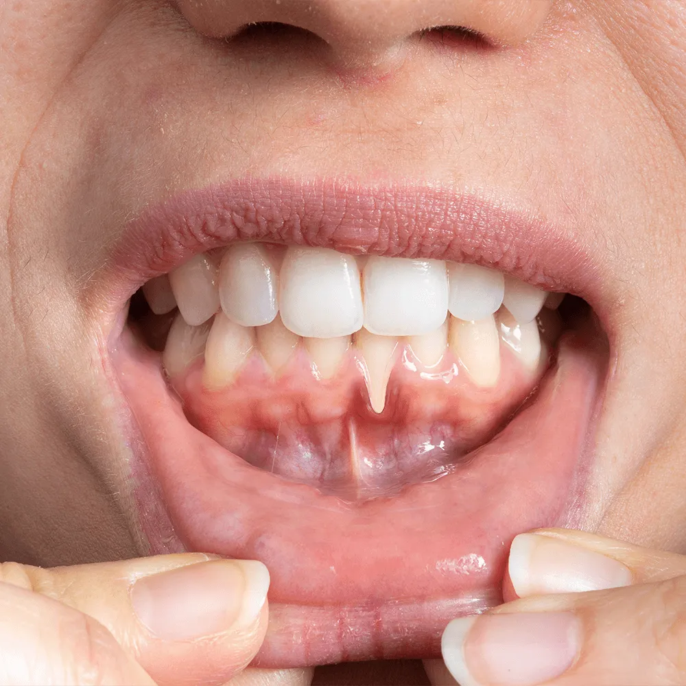 Close-up of a person's mouth revealing a small, pointed tooth between the lower incisors.