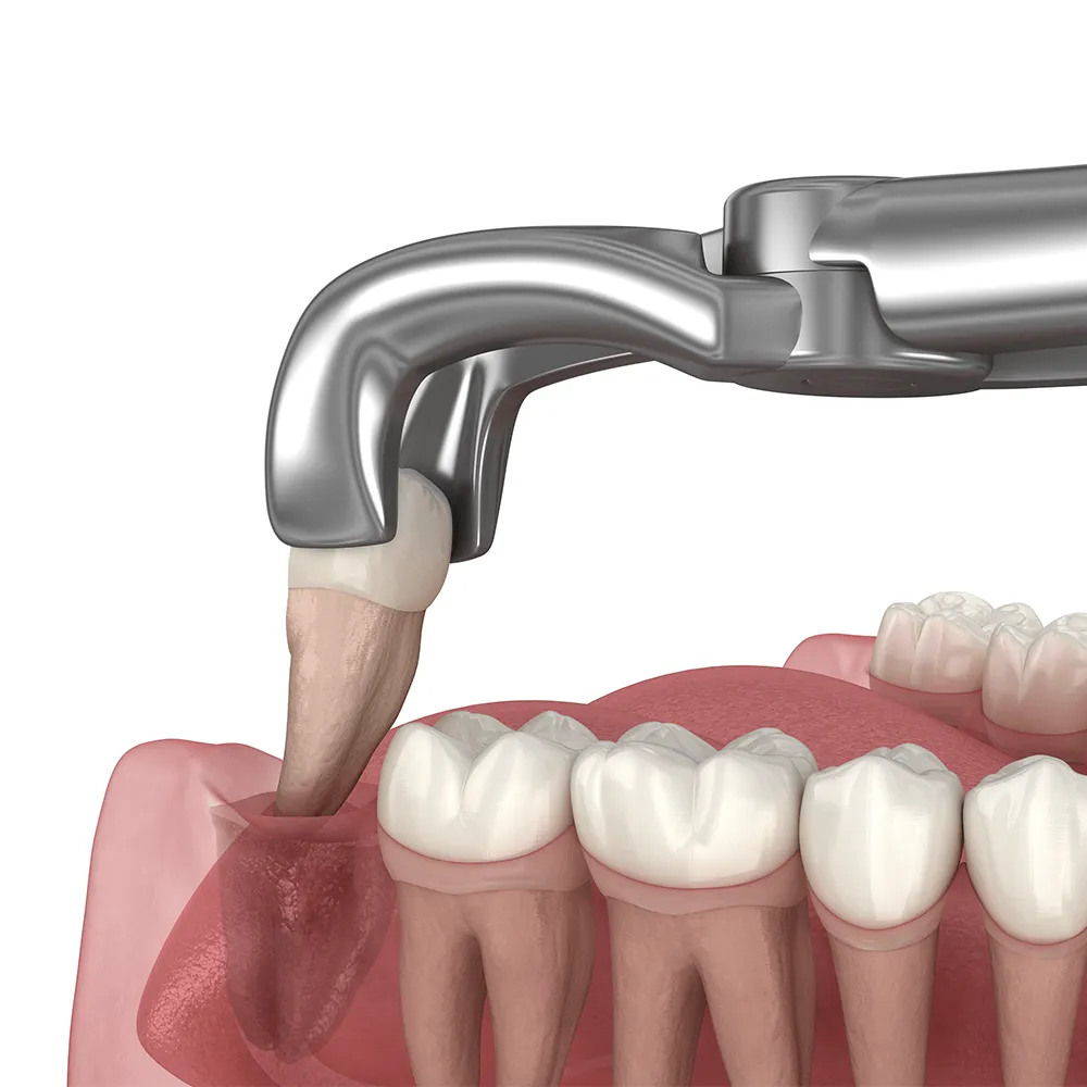 Dental tool extracting a tooth from gums in 3D illustration.